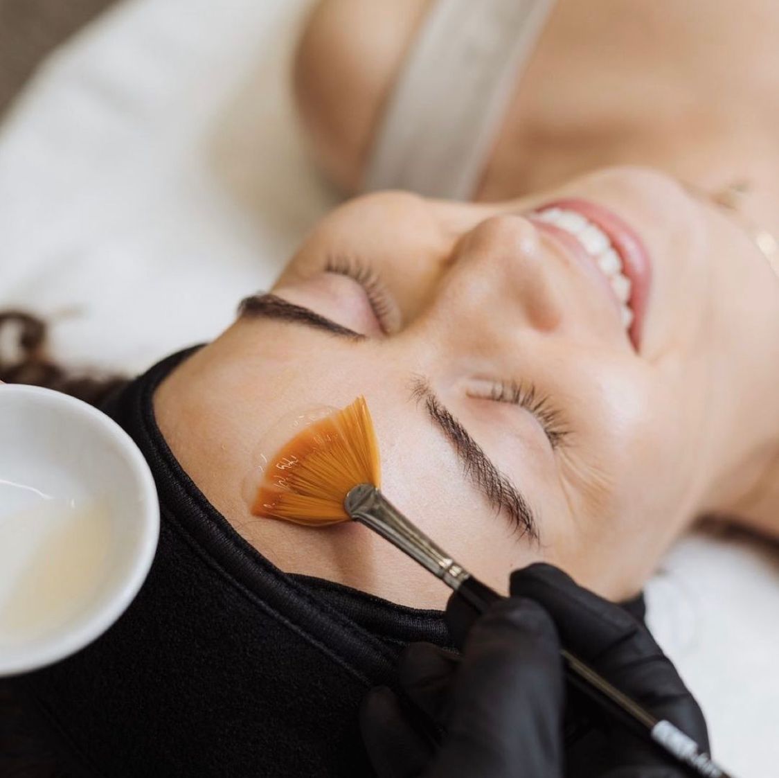 Chemical Peel
